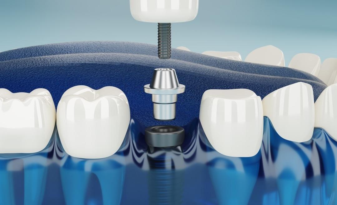 Protesi dentale fissa: come avere denti nuovi e fissi in 24 ore? -  Gallottini & Partners - Ambulatorio Odontoiatrico