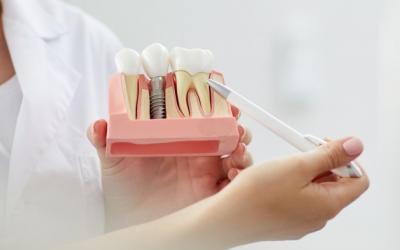 Impianti dentali in anestesia: addio al dolore!