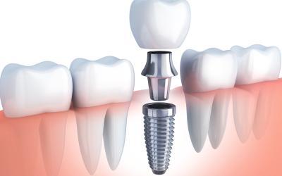 Impianti Dentali: controindicazioni