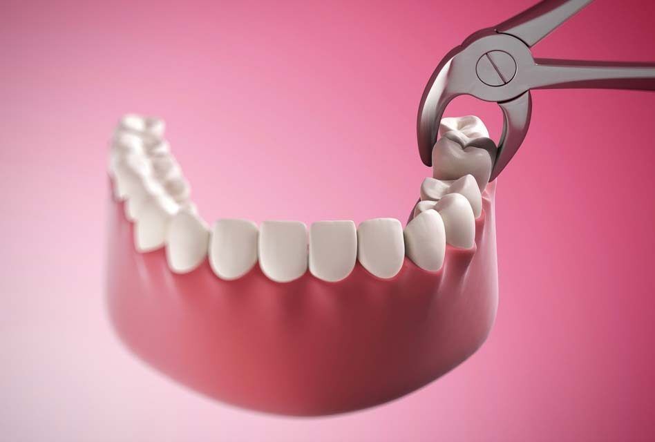 Estrazione denti: costi e modalità - Gallottini