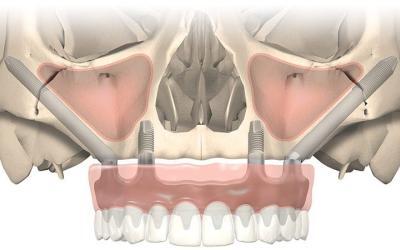Benefici degli Impianti Zigomatici