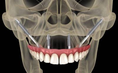 È possibile inserire gli Impianti Dentali Senza Osso?