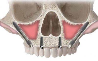 Hai perso la speranza di avere Denti Fissi senza osso?