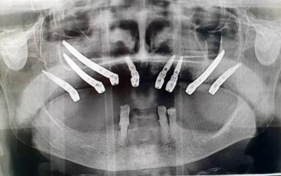 Impianti Zigomatici e Pterigoidei nei Denti Superiori