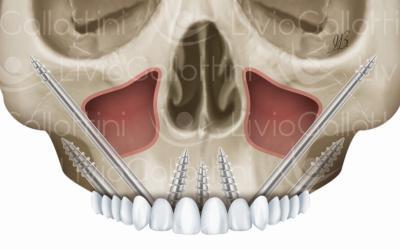 Impianti zigomatici e carico immediato: vantaggi e modalità