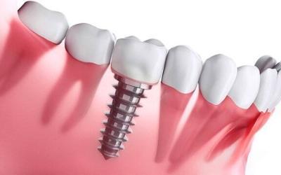 Impianti dentali a Roma in anestesia totale