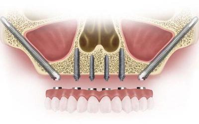 Impianti e Denti Fissi nell’arcata superiore a Roma e Milano