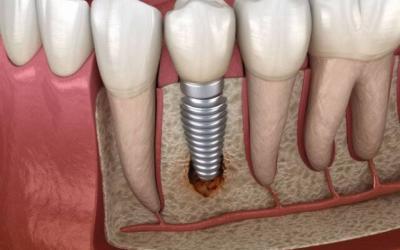 Parodontite, impianti e denti fissi a Roma