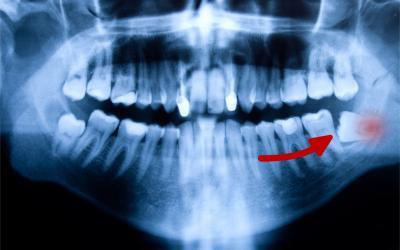 Estrazione denti del giudizio a Ostia. Fanno male le estrazioni e quanto costano?