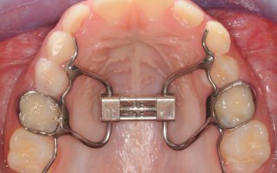 Apparecchio a denti per palato stretto negli adulti: perché, come, quando, dove e quanto costa