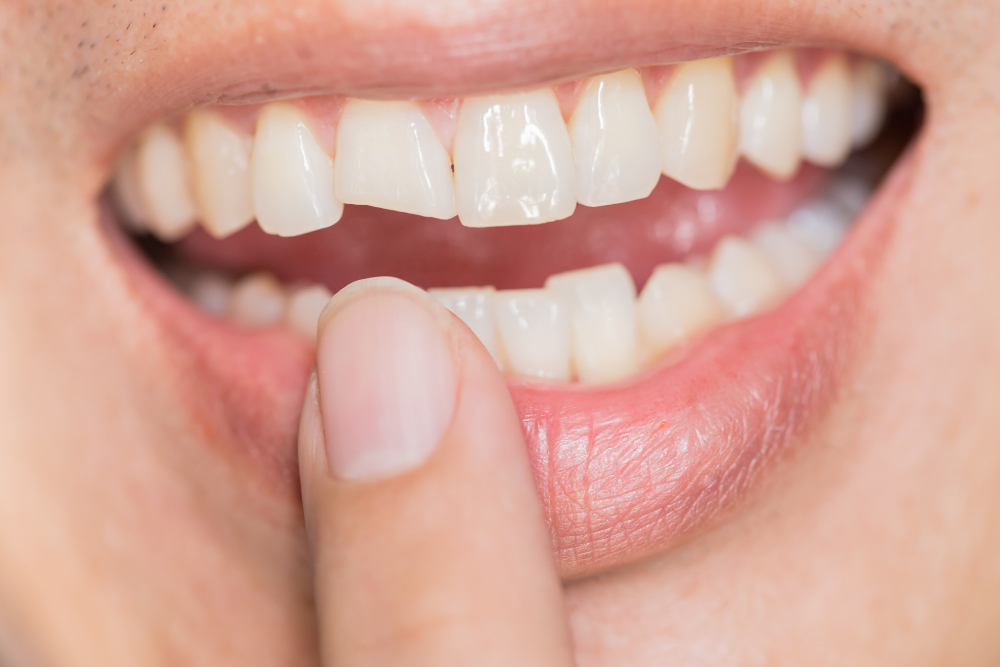 Ricostruzione dente spezzato o scheggiato: dentista vicino Ostia Lido e Ostia Antica